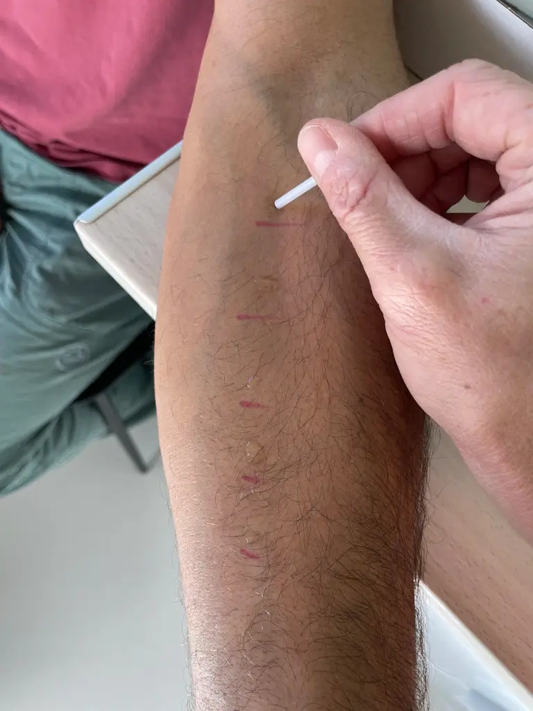 Tests cutanés aux pneumallergènes
