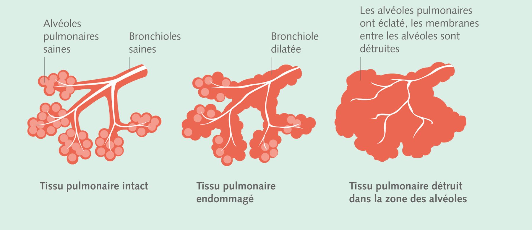Emphysème pulomonaire