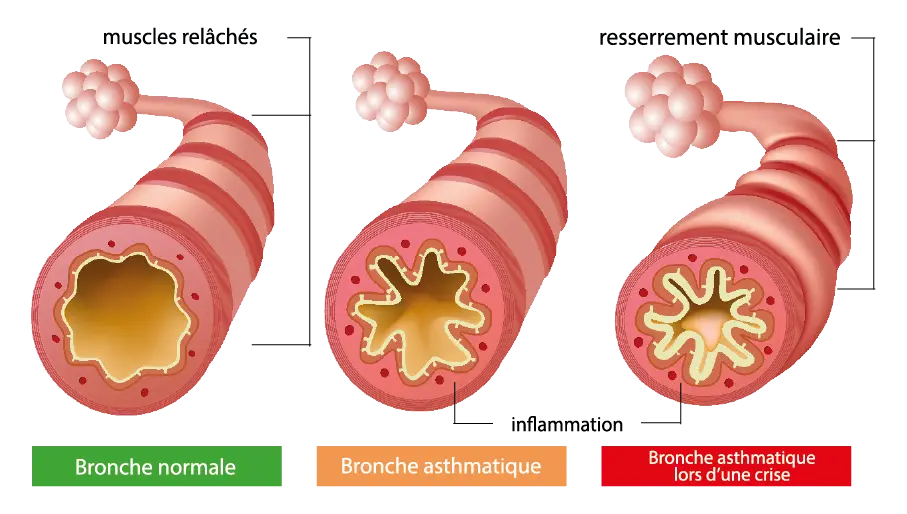 Mécanisme de l'asthme